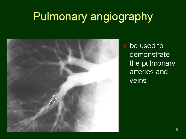 Pulmonary angiography Ø be used to demonstrate the pulmonary arteries and veins 8 