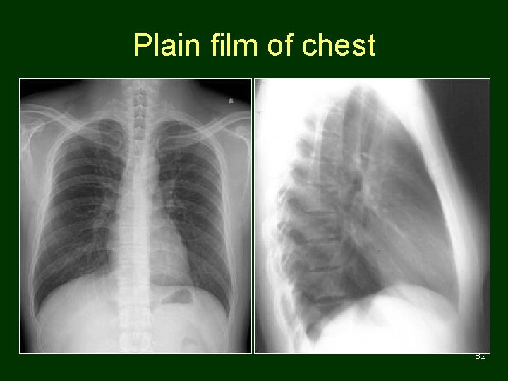 Plain film of chest 82 