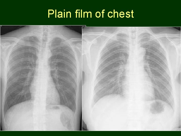 Plain film of chest 93 