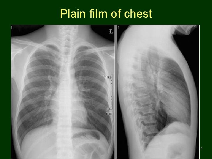 Plain film of chest 94 
