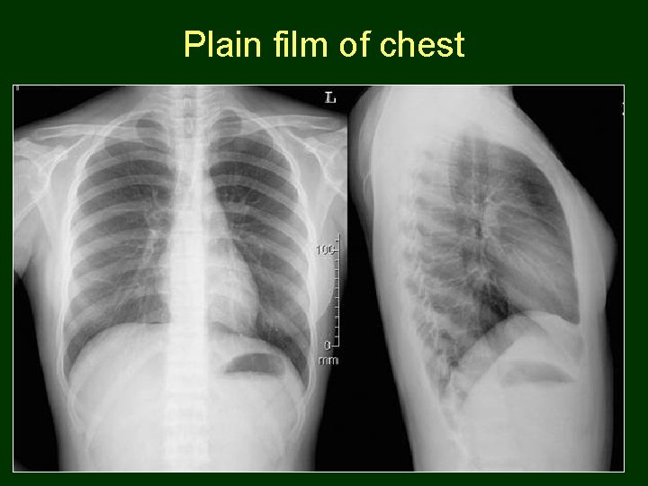 Plain film of chest 95 