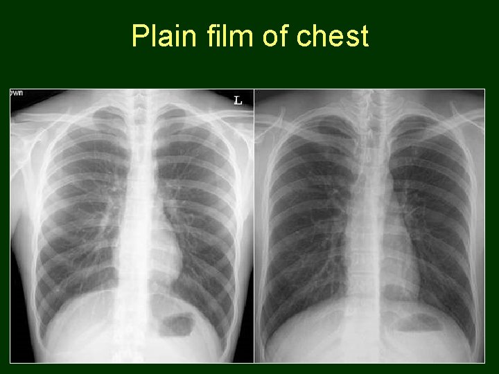Plain film of chest 96 