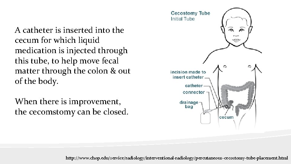 A catheter is inserted into the cecum for which liquid medication is injected through