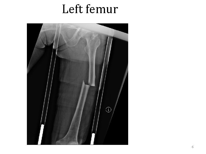 Left femur 6 