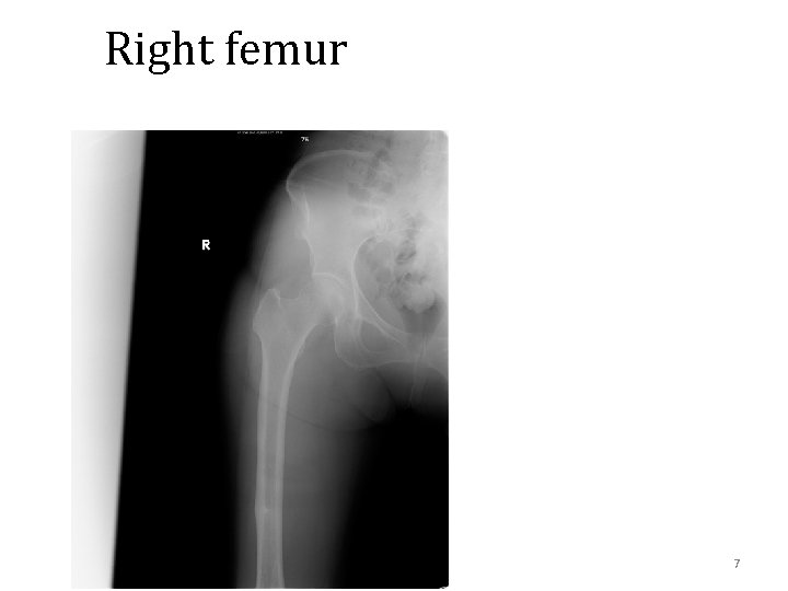 Right femur 7 