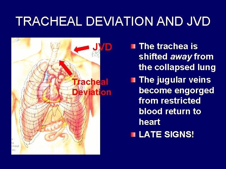 TRACHEAL DEVIATION AND JVD Tracheal Deviation The trachea is shifted away from the collapsed