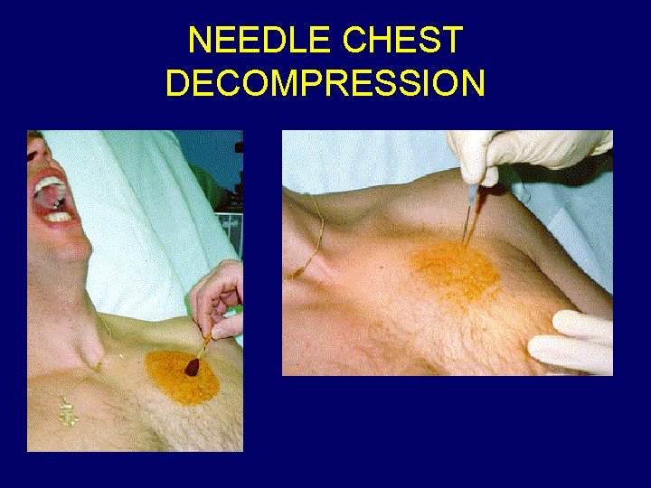 NEEDLE CHEST DECOMPRESSION 