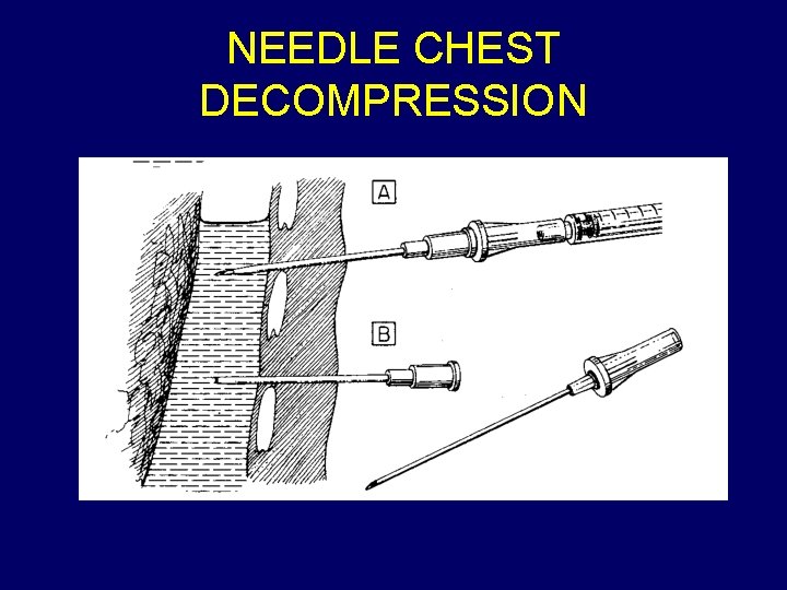 NEEDLE CHEST DECOMPRESSION 