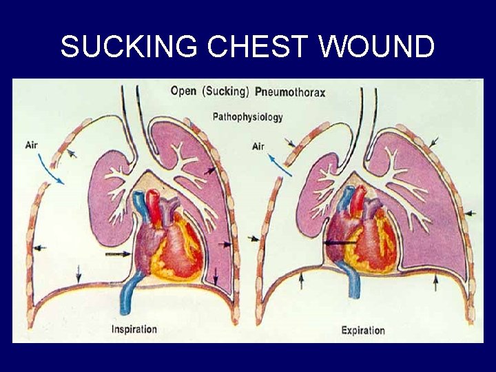 SUCKING CHEST WOUND 