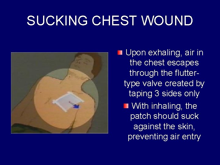 SUCKING CHEST WOUND Upon exhaling, air in the chest escapes through the fluttertype valve