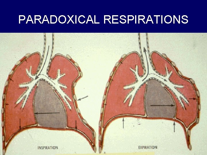 PARADOXICAL RESPIRATIONS 