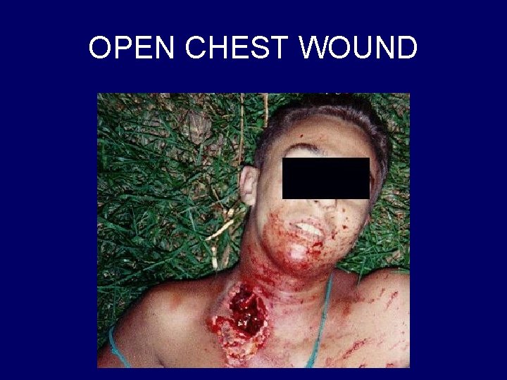 OPEN CHEST WOUND 