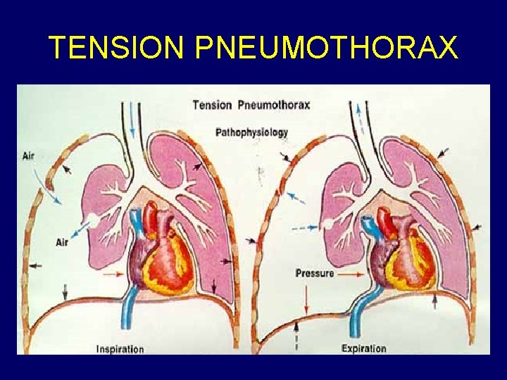 TENSION PNEUMOTHORAX 