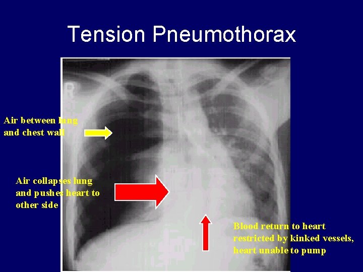 Tension Pneumothorax Air between lung and chest wall Air collapses lung and pushes heart