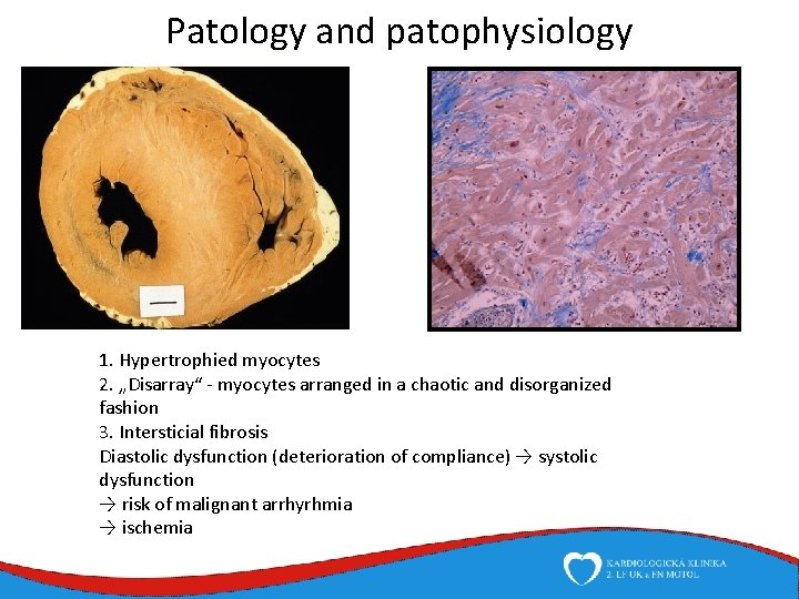 Patology and patophysiology 1. Hypertrophied myocytes 2. „Disarray“ - myocytes arranged in a chaotic