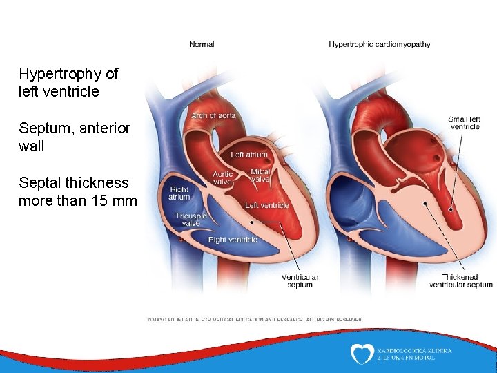 Hypertrophy of left ventricle Septum, anterior wall Septal thickness more than 15 mm 