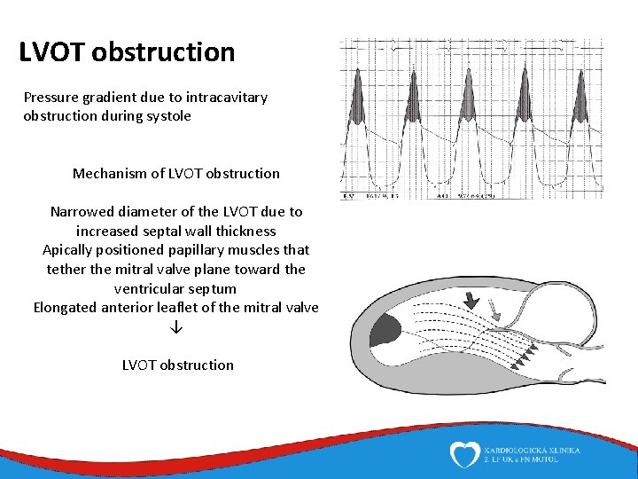 LVOT obstruction Pressure gradient due to intracavitary obstruction during systole Mechanism of LVOT obstruction