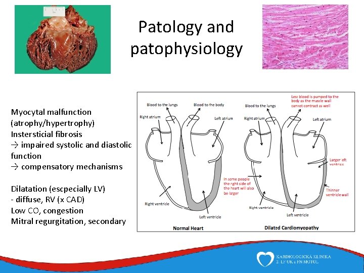 Patology and patophysiology Myocytal malfunction (atrophy/hypertrophy) Instersticial fibrosis → impaired systolic and diastolic function