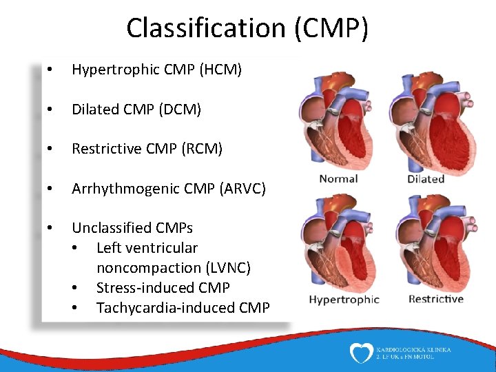 Classification (CMP) • Hypertrophic CMP (HCM) • Dilated CMP (DCM) • Restrictive CMP (RCM)