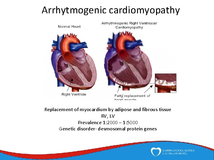 Arrhytmogenic cardiomyopathy Replacement of myocardium by adipose and fibrous tissue RV, LV Prevalence 1: