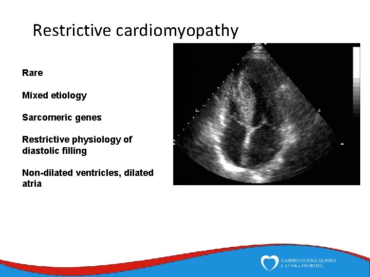 Restrictive cardiomyopathy Rare Mixed etiology Sarcomeric genes Restrictive physiology of diastolic filling Non-dilated ventricles,