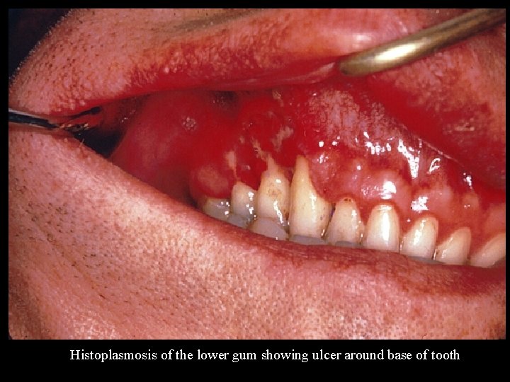 Histoplasmosis of the lower gum showing ulcer around base of tooth 