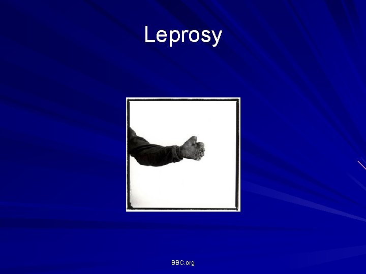Leprosy BBC. org Leprosy BBC. org