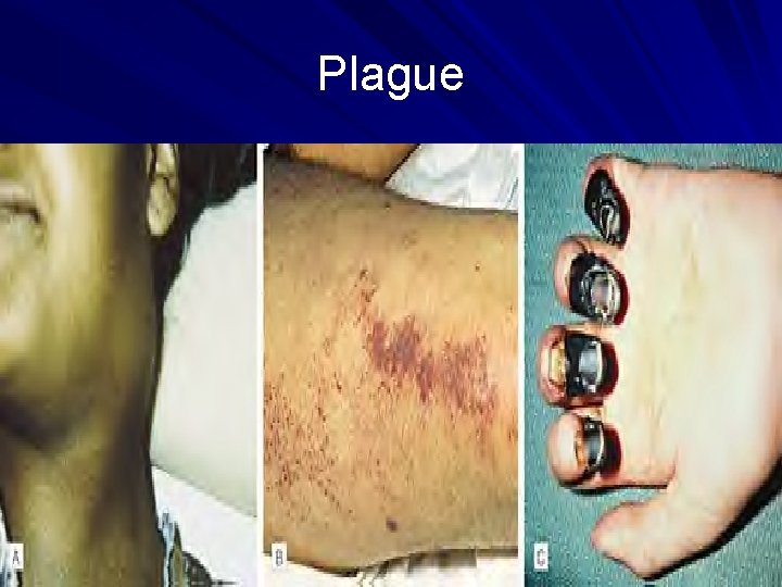 Plague Plague