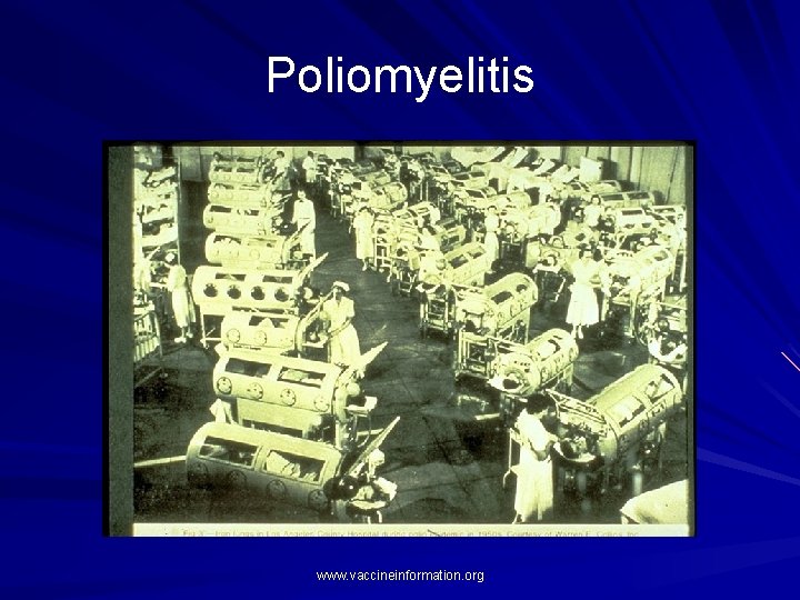 Poliomyelitis www. vaccineinformation. org Poliomyelitis www. vaccineinformation. org