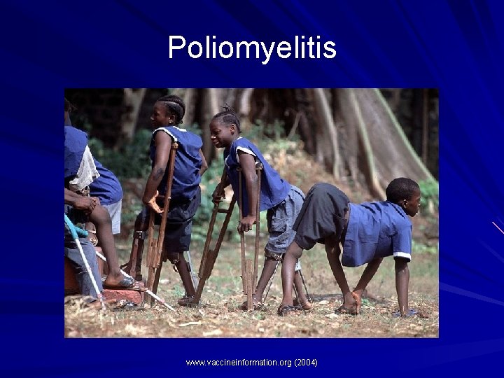 Poliomyelitis www. vaccineinformation. org (2004) Poliomyelitis www. vaccineinformation. org (2004)