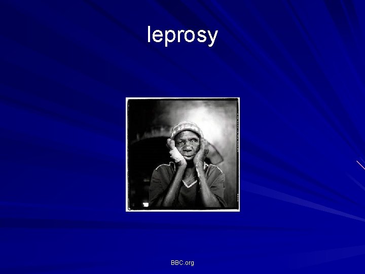 leprosy BBC. org leprosy BBC. org