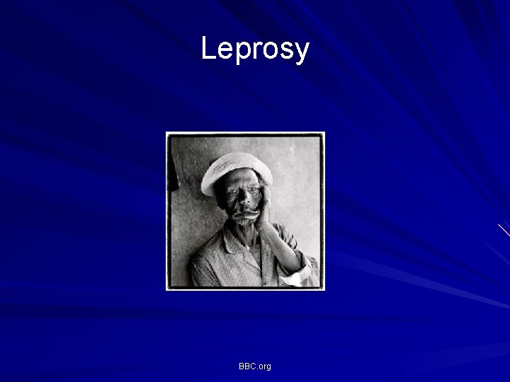 Leprosy BBC. org Leprosy BBC. org