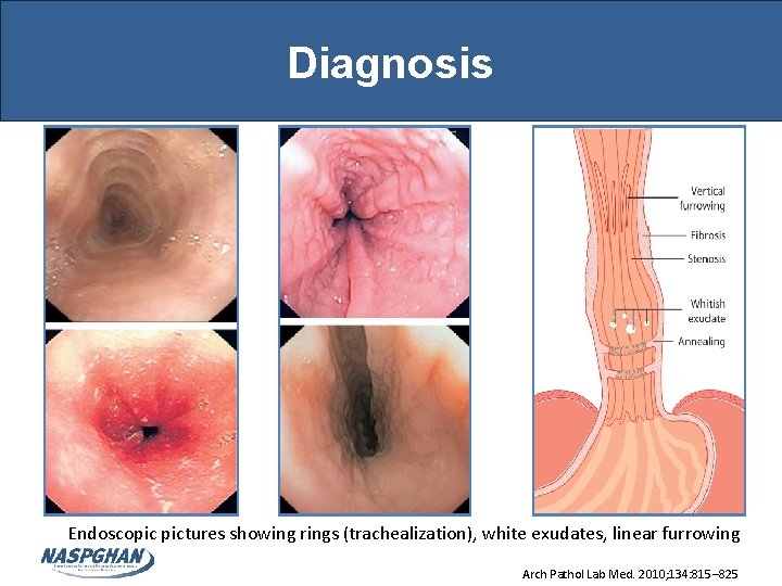 Diagnosis Endoscopic pictures showing rings (trachealization), white exudates, linear furrowing Arch Pathol Lab Med. Diagnosis Endoscopic pictures showing rings (trachealization), white exudates, linear furrowing Arch Pathol Lab Med.