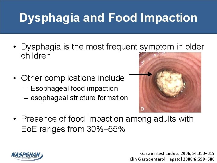 Dysphagia and Food Impaction • Dysphagia is the most frequent symptom in older children Dysphagia and Food Impaction • Dysphagia is the most frequent symptom in older children