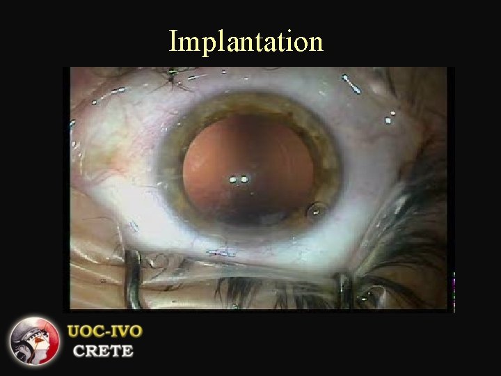 Implantation 