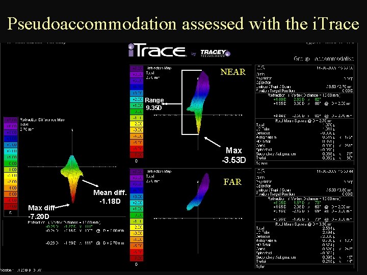Pseudoaccommodation assessed with the i. Trace NEAR Range 9. 35 D Max -3. 53