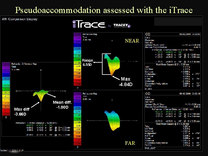 Pseudoaccommodation assessed with the i. Trace NEAR Range 6. 55 D Max -4. 84