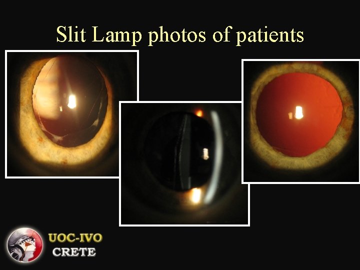 Slit Lamp photos of patients 