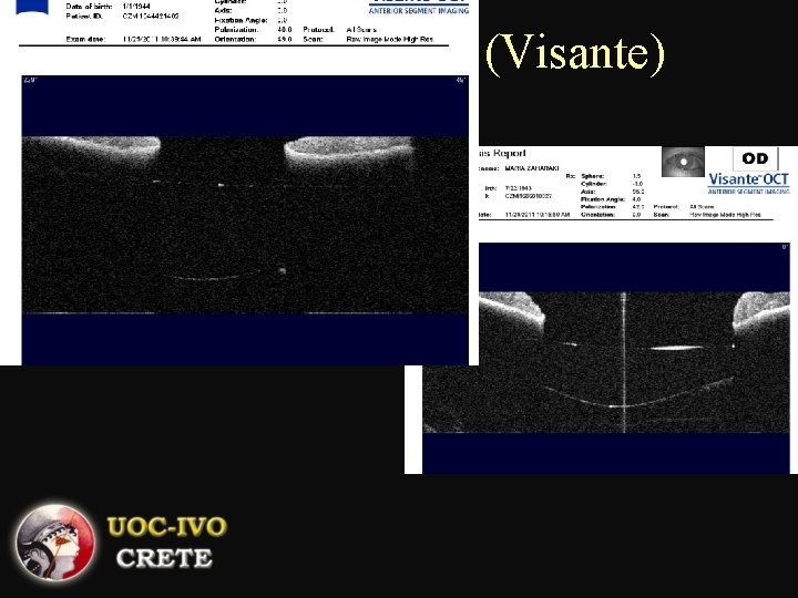 AS – OCT image (Visante) 