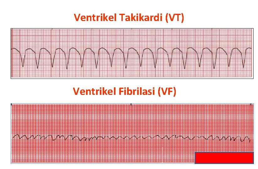 Ventrikel Takikardi (VT) Ventrikel Fibrilasi (VF) 