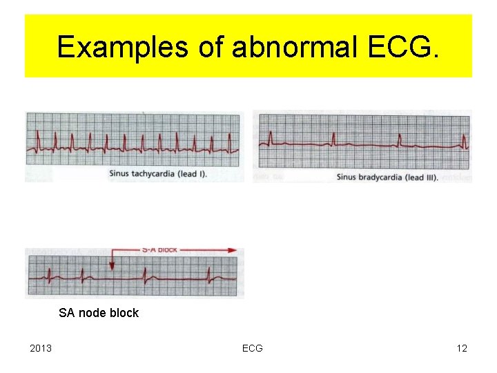 Examples of abnormal ECG. SA node block 2013 ECG 12 