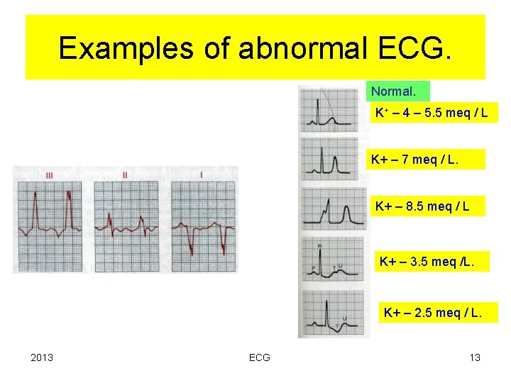 Examples of abnormal ECG. Normal. K+ – 4 – 5. 5 meq / L