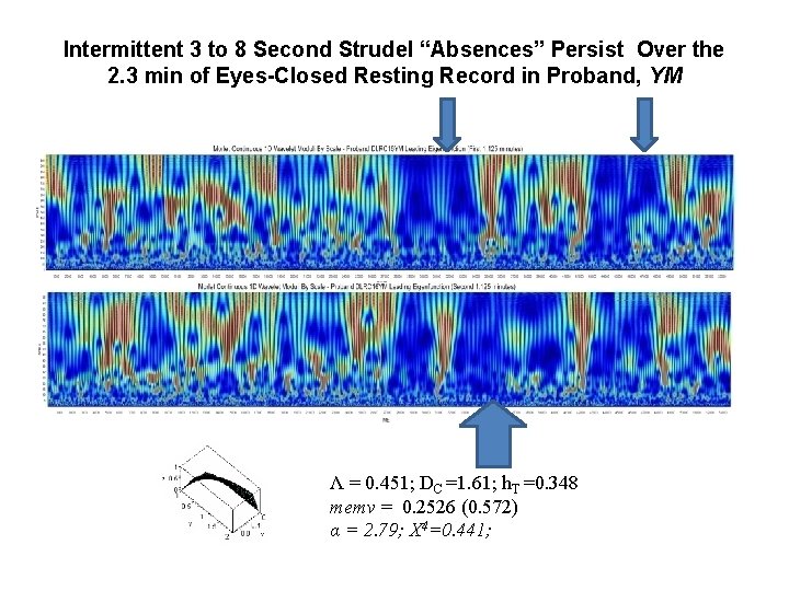 Intermittent 3 to 8 Second Strudel “Absences” Persist Over the 2. 3 min of