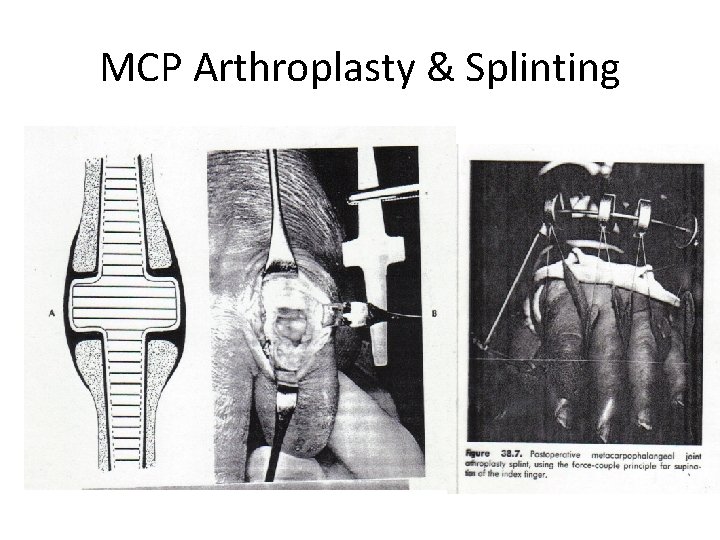 MCP Arthroplasty & Splinting 