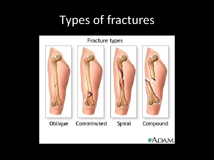 Types of fractures 