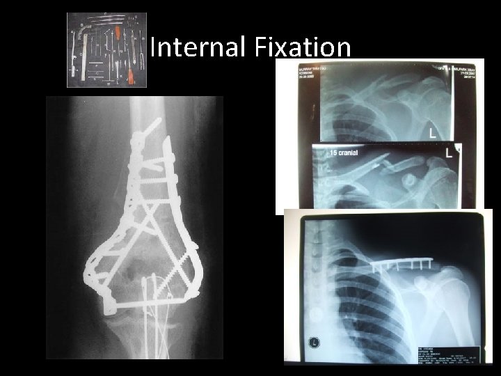 Internal Fixation 