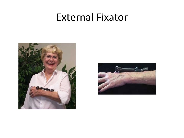 External Fixator 