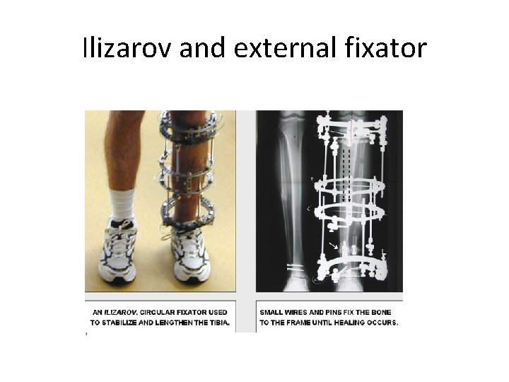 Ilizarov and external fixator 