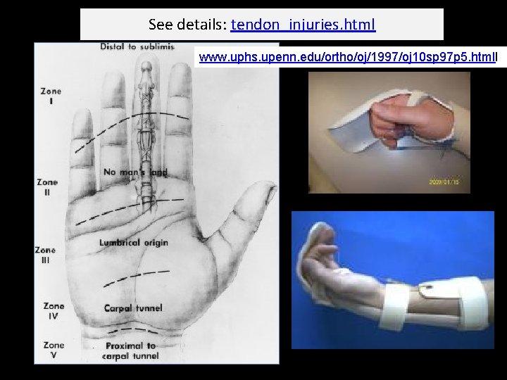 See details: tendon_injuries. html www. uphs. upenn. edu/ortho/oj/1997/oj 10 sp 97 p 5. htmll
