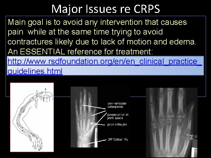 Major Issues re CRPS Main goal is to avoid any intervention that causes pain